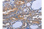 The image on the left is immunohistochemistry of paraffin-embedded Human thyroid cancer tissue using CSB-PA905788(AQP8 Antibody) at dilution 1/20, on the right is treated with synthetic peptide. (Original magnification: 
