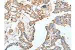 The image on the left is immunohistochemistry of paraffin-embedded Human thyroid cancer tissue using CSB-PA906019(ACTN1 Antibody) at dilution 1/10, on the right is treated with fusion protein. (Original magnification: 
