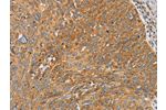 The image on the left is immunohistochemistry of paraffin-embedded Human cervical cancer tissue using CSB-PA906091(ARSK Antibody) at dilution 1/20, on the right is treated with fusion protein. (Original magnification: 