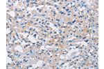 The image on the left is immunohistochemistry of paraffin-embedded Human thyroid cancer tissue using CSB-PA906170(ATP6AP2 Antibody) at dilution 1/50, on the right is treated with fusion protein. (Original magnification: 
