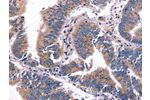 The image on the left is immunohistochemistry of paraffin-embedded Human colon cancer tissue using CSB-PA906268(ARC Antibody) at dilution 1/50, on the right is treated with fusion protein. (Original magnification: 