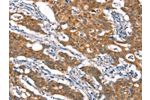 The image on the left is immunohistochemistry of paraffin-embedded Human gastic cancer tissue using CSB-PA906934(CYLD Antibody) at dilution 1/35, on the right is treated with synthetic peptide. (Original magnification: 