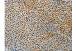 The image on the left is immunohistochemistry of paraffin-embedded Human liver cancer tissue using CSB-PA907155(BAAT Antibody) at dilution 1/30, on the right is treated with fusion protein. (Original magnification: 