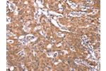 The image on the left is immunohistochemistry of paraffin-embedded Human gastic cancer tissue using CSB-PA907885(FBXO31 Antibody) at dilution 1/40, on the right is treated with synthetic peptide. (Original magnification: 