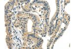 The image on the left is immunohistochemistry of paraffin-embedded Human thyroid cancer tissue using CSB-PA908097(CCL13 Antibody) at dilution 1/40, on the right is treated with synthetic peptide. (Original magnification: 