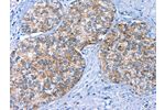 The image on the left is immunohistochemistry of paraffin-embedded Human prostate cancer tissue using CSB-PA908140(BCAM Antibody) at dilution 1/40, on the right is treated with fusion protein. (Original magnification: 