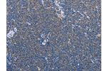 The image on the left is immunohistochemistry of paraffin-embedded Human Lymphoma tissue using CSB-PA908401(AMY2A Antibody) at dilution 1/60, on the right is treated with fusion protein. (Original magnification: 