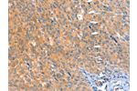 The image on the left is immunohistochemistry of paraffin-embedded Human cervical cancer tissue using CSB-PA908473(ACOX3 Antibody) at dilution 1/25, on the right is treated with fusion protein. (Original magnification: 