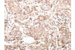 The image on the left is immunohistochemistry of paraffin-embedded Human breast cancer tissue using CSB-PA908796(pan CDH Antibody) at dilution 1/20, on the right is treated with synthetic peptide. (Original magnification: 