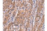 The image on the left is immunohistochemistry of paraffin-embedded Human gastic cancer tissue using CSB-PA908823(BCL6 Antibody) at dilution 1/15, on the right is treated with synthetic peptide. (Original magnification: 