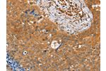The image on the left is immunohistochemistry of paraffin-embedded Human cervical cancer tissue using CSB-PA908870(ACOT11 Antibody) at dilution 1/25, on the right is treated with fusion protein. (Original magnification: 