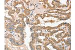 The image on the left is immunohistochemistry of paraffin-embedded Human thyroid cancer tissue using CSB-PA909378(ADAM10 Antibody) at dilution 1/30, on the right is treated with fusion protein. (Original magnification: 