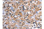 The image on the left is immunohistochemistry of paraffin-embedded Human thyroid cancer tissue using CSB-PA909503(COMP Antibody) at dilution 1/50, on the right is treated with fusion protein. (Original magnification: 