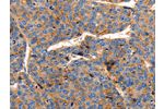 The image on the left is immunohistochemistry of paraffin-embedded Human liver cancer tissue using CSB-PA909627(CLDN1 Antibody) at dilution 1/150, on the right is treated with synthetic peptide. (Original magnification: 
