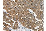 The image on the left is immunohistochemistry of paraffin-embedded Human ovarian cancer tissue using CSB-PA909687(ABCD2 Antibody) at dilution 1/20, on the right is treated with synthetic peptide. (Original magnification: 
