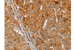The image on the left is immunohistochemistry of paraffin-embedded Human liver cancer tissue using CSB-PA909692(ARSG Antibody) at dilution 1/30, on the right is treated with fusion protein. (Original magnification: 