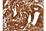 The image on the left is immunohistochemistry of paraffin-embedded Human gastic cancer tissue using CSB-PA909976(ALDOA Antibody) at dilution 1/25, on the right is treated with fusion protein. (Original magnification: 