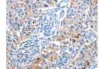 The image on the left is immunohistochemistry of paraffin-embedded Human lung cancer tissue using CSB-PA910215(ACYP1 Antibody) at dilution 1/25, on the right is treated with fusion protein. (Original magnification: 