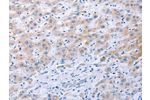 The image on the left is immunohistochemistry of paraffin-embedded Human liver cancer tissue using CSB-PA910266(FGF4 Antibody) at dilution 1/40, on the right is treated with synthetic peptide. (Original magnification: 