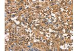 The image on the left is immunohistochemistry of paraffin-embedded Human thyroid cancer tissue using CSB-PA910490(DNM2 Antibody) at dilution 1/40, on the right is treated with synthetic peptide. (Original magnification: 