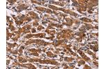 The image on the left is immunohistochemistry of paraffin-embedded Human breast cancer tissue using CSB-PA910505(CYP2W1 Antibody) at dilution 1/25, on the right is treated with fusion protein. (Original magnification: 
