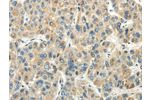 The image on the left is immunohistochemistry of paraffin-embedded Human liver cancer tissue using CSB-PA910897(CHGB Antibody) at dilution 1/30, on the right is treated with synthetic peptide. (Original magnification: 