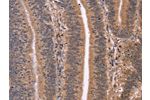 The image on the left is immunohistochemistry of paraffin-embedded Human colon cancer tissue using CSB-PA911084(CLUAP1 Antibody) at dilution 1/50, on the right is treated with fusion protein. (Original magnification: 