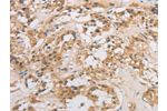 The image on the left is immunohistochemistry of paraffin-embedded Human thyroid cancer tissue using CSB-PA911773(DCTN5 Antibody) at dilution 1/20, on the right is treated with fusion protein. (Original magnification: 