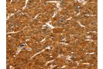 The image on the left is immunohistochemistry of paraffin-embedded Human liver cancer tissue using CSB-PA911864(COLEC11 Antibody) at dilution 1/20, on the right is treated with fusion protein. (Original magnification: 