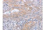 The image on the left is immunohistochemistry of paraffin-embedded Human cervical cancer tissue using CSB-PA911937(BOD1 Antibody) at dilution 1/30, on the right is treated with synthetic peptide. (Original magnification: 