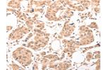 The image on the left is immunohistochemistry of paraffin-embedded Human breast cancer tissue using CSB-PA911950(ACIN1 Antibody) at dilution 1/30, on the right is treated with synthetic peptide. (Original magnification: 