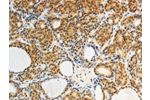 The image on the left is immunohistochemistry of paraffin-embedded Human thyroid cancer tissue using CSB-PA912094(AKR1A1 Antibody) at dilution 1/25, on the right is treated with synthetic peptide. (Original magnification: 