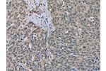 The image on the left is immunohistochemistry of paraffin-embedded Human cervical cancer tissue using CSB-PA912176(ESR2 Antibody) at dilution 1/20, on the right is treated with fusion protein. (Original magnification: 