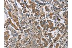 The image on the left is immunohistochemistry of paraffin-embedded Human breast cancer tissue using CSB-PA913264(CYP4A11 Antibody) at dilution 1/25, on the right is treated with fusion protein. (Original magnification: 