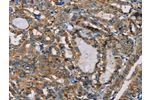 The image on the left is immunohistochemistry of paraffin-embedded Human thyroid cancer tissue using CSB-PA913376(CENPU Antibody) at dilution 1/20, on the right is treated with fusion protein. (Original magnification: 