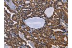 The image on the left is immunohistochemistry of paraffin-embedded Human thyroid cancer tissue using CSB-PA913546(ADRBK2 Antibody) at dilution 1/50, on the right is treated with fusion protein. (Original magnification: 