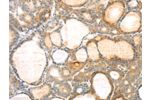 The image on the left is immunohistochemistry of paraffin-embedded Human thyroid cancer tissue using CSB-PA913716(EVA1A Antibody) at dilution 1/30, on the right is treated with synthetic peptide. (Original magnification: 