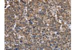 The image on the left is immunohistochemistry of paraffin-embedded Human liver cancer tissue using CSB-PA914047(EPOR Antibody) at dilution 1/30, on the right is treated with synthetic peptide. (Original magnification: 