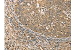 The image on the left is immunohistochemistry of paraffin-embedded Human cervical cancer tissue using CSB-PA914063(ATG3 Antibody) at dilution 1/40, on the right is treated with fusion protein. (Original magnification: 