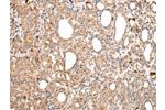 The image on the left is immunohistochemistry of paraffin-embedded Human thyroid cancer tissue using CSB-PA914369(AXIN1  Antibody) at dilution 1/30, on the right is treated with synthetic peptide. (Original magnification: 