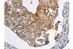 The image on the left is immunohistochemistry of paraffin-embedded Human breast cancer tissue using CSB-PA914467(ABCC3 Antibody) at dilution 1/20, on the right is treated with synthetic peptide. (Original magnification: 