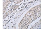 The image on the left is immunohistochemistry of paraffin-embedded Human breast cancer tissue using CSB-PA914946(ABLIM1 Antibody) at dilution 1/30, on the right is treated with fusion protein. (Original magnification: 