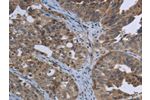 The image on the left is immunohistochemistry of paraffin-embedded Human ovarian cancer tissue using CSB-PA915371(EPHA10 Antibody) at dilution 1/20, on the right is treated with fusion protein. (Original magnification: 