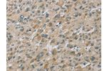 The image on the left is immunohistochemistry of paraffin-embedded Human liver cancer tissue using CSB-PA915667(EIF5 Antibody) at dilution 1/25, on the right is treated with fusion protein. (Original magnification: 