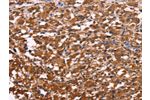 The image on the left is immunohistochemistry of paraffin-embedded Human thyroid cancer tissue using CSB-PA915948(APMAP Antibody) at dilution 1/30, on the right is treated with synthetic peptide. (Original magnification: 