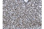 The image on the left is immunohistochemistry of paraffin-embedded Human lung cancer tissue using CSB-PA916076(CMTM2 Antibody) at dilution 1/60, on the right is treated with fusion protein. (Original magnification: 
