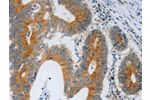 The image on the left is immunohistochemistry of paraffin-embedded Human colon cancer tissue using CSB-PA916397(F2R Antibody) at dilution 1/40, on the right is treated with synthetic peptide. (Original magnification: 