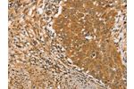 The image on the left is immunohistochemistry of paraffin-embedded Human cervical cancer tissue using CSB-PA916723(ARMCX3 Antibody) at dilution 1/40, on the right is treated with fusion protein. (Original magnification: 