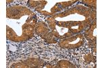 The image on the left is immunohistochemistry of paraffin-embedded Human cervical cancer tissue using CSB-PA916741(GATA6 Antibody) at dilution 1/35, on the right is treated with synthetic peptide. (Original magnification: 