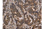 The image on the left is immunohistochemistry of paraffin-embedded Human liver cancer tissue using CSB-PA916967(FMR1 Antibody) at dilution 1/30, on the right is treated with fusion protein. (Original magnification: 